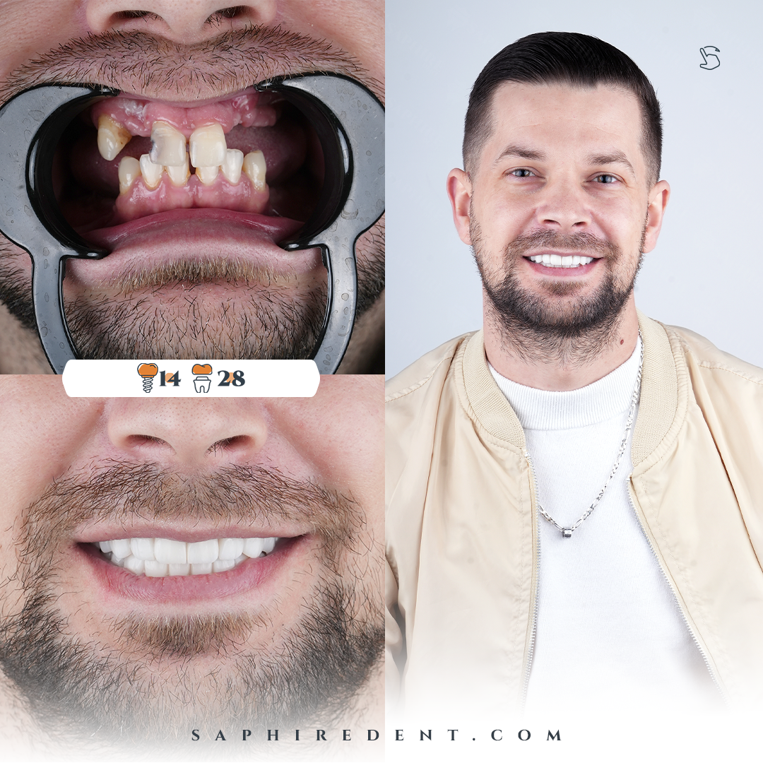 Dental Implants